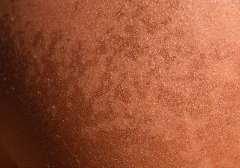 Foto macro de uma pele manchada após sofrer de insolação